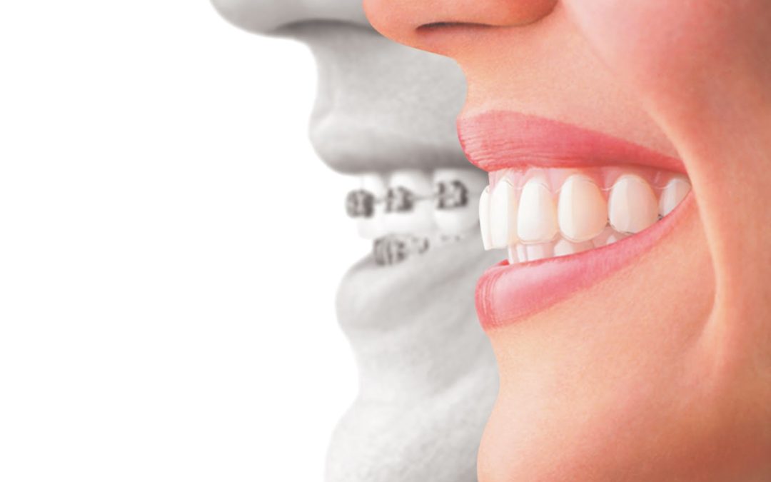 Ask Your Copperas Cove, Taylor or Belton Dentist: What’s the difference between Invisalign and Metal Braces?