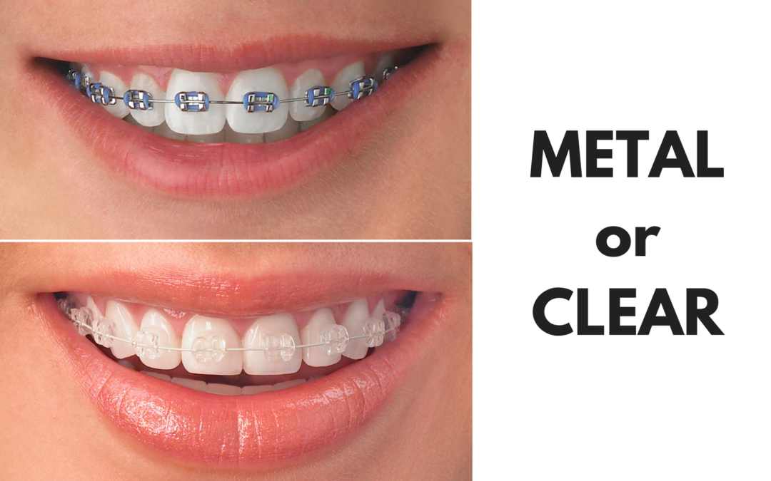 Ask Your Copperas Cove, Taylor, Belton or Manor Dentist: Should I Get Metal or Clear Braces?