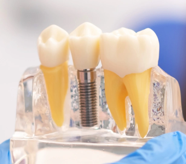 Dental implant comparison model showing natural tooth, implant fixture, and crown on transparent display.
