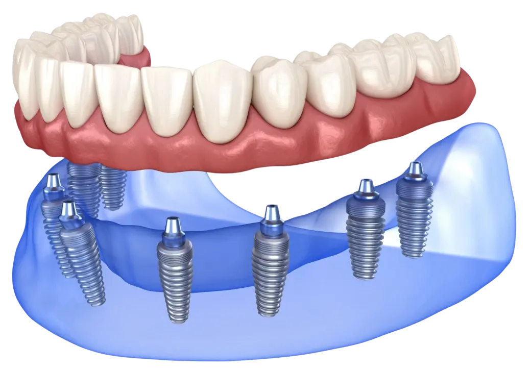 Dental implant illustration showing prosthetic teeth supported by multiple implants in jawbone.
