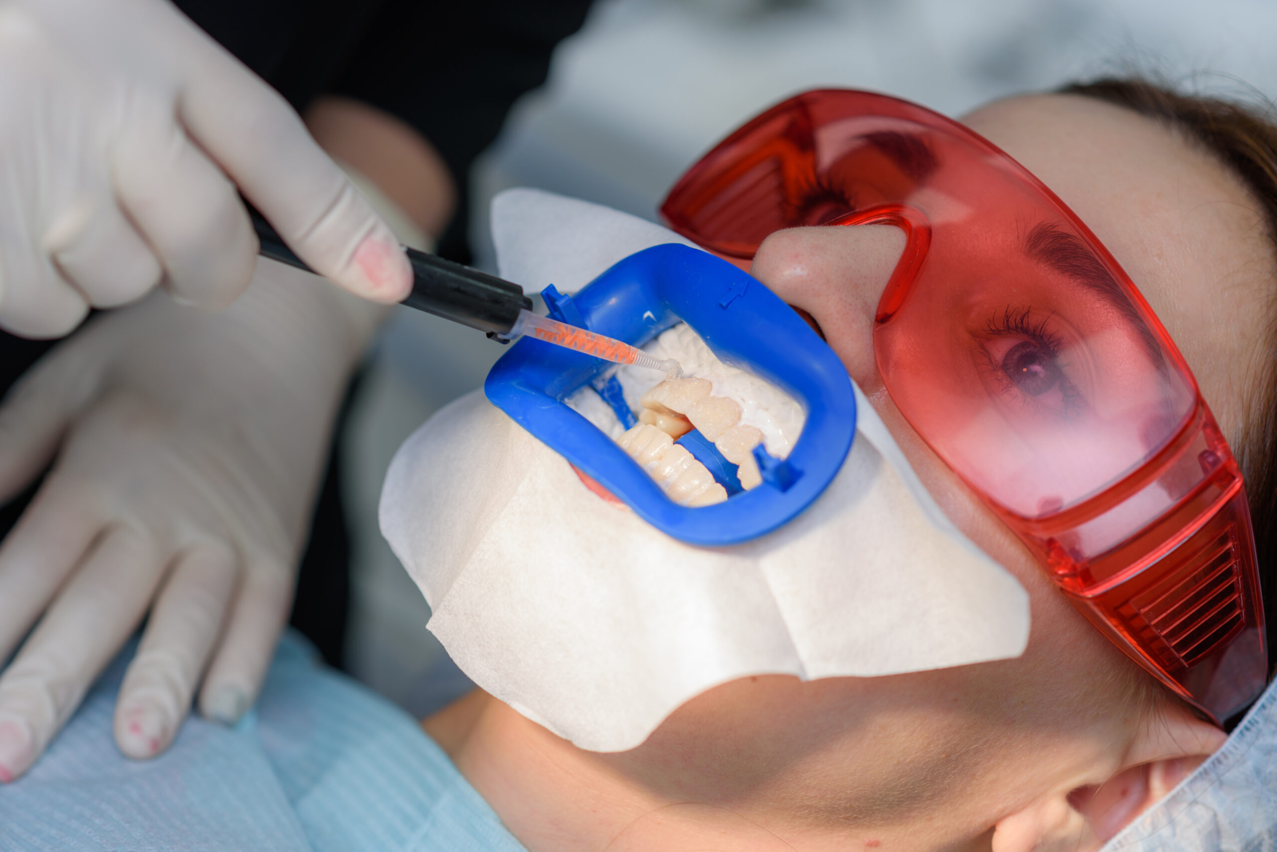 Dentist in gloves applying blue dental material to patient's teeth model during orthodontic treatment demonstration.