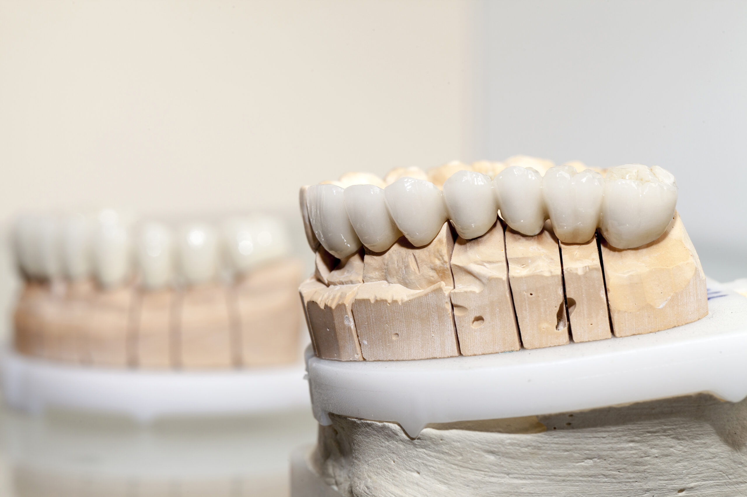 Dental crown and bridge models displayed on white platforms in a dental laboratory setting.