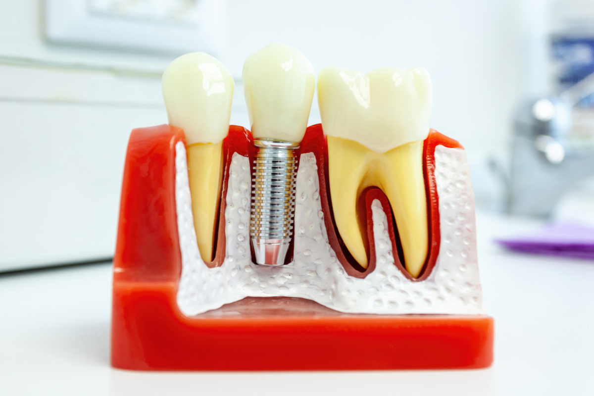 Dental Implants copperas cove