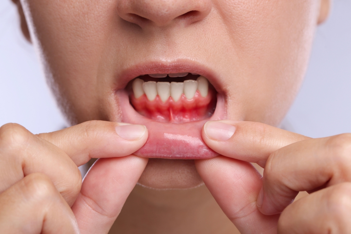 Can gum disease be reversed without surgery?